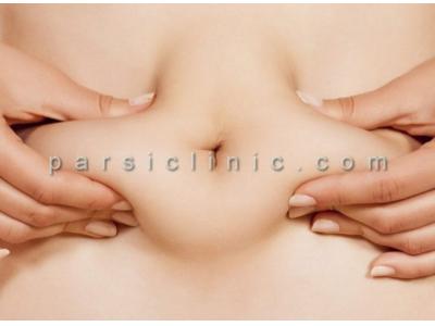 لیپوساکشن بدن شمال تهران