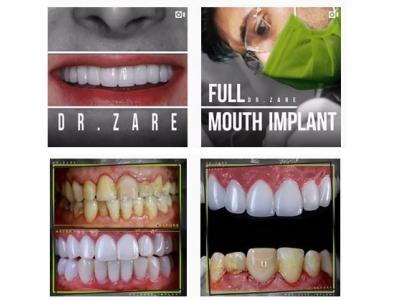 متخصص کاشت ایمپلنت در مشهد 