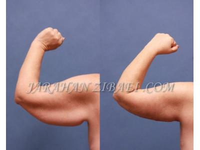 عمل لیپوماتیک شکم و پهلو