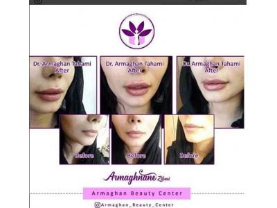 لیپوماتیک ، لیزر ، پیکرتراشی ، تزریق ژل و بوتاکس 