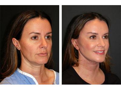 لیفت صورت در تهران