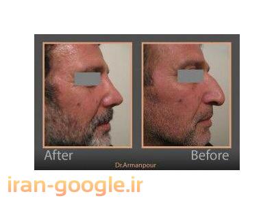 جراحی پلاستیک بینی و شکم ، پروتز سینه