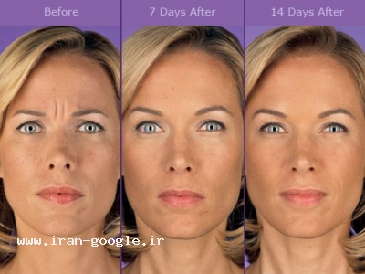 ويژه عيد نوروز:انجام بوتاكس ورفع موهاي زائد باليزر