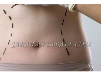 جراحی های زیبایی شکم-عمل لیپوماتیک شکم و پهلو