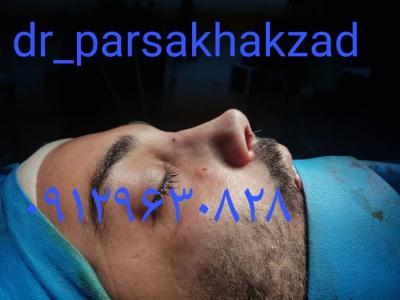پروتز چانه-  دکتر پارسا خاکزاد جراحی زیبایی بینی ،  جراحی افتادگی پلک ، جراحی زیبایی گوش