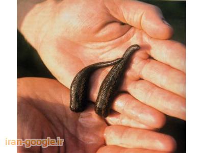 زالو درمانی در شیراز