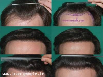 کلینیک فوق تخصصی کاشت مو وترمیم موی رنسانس 