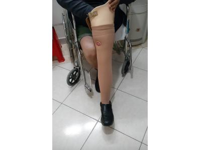کلینیک تخصصی ساخت پای مصنوعی کرج