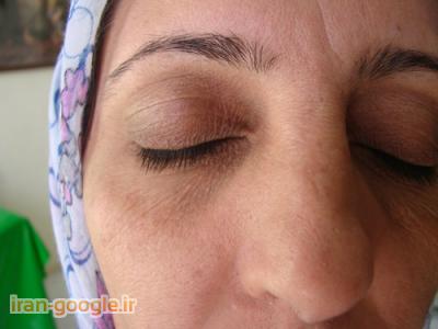 لک و چروک پوست-زالو درمانی در شیراز