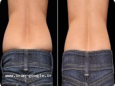 کلینیک تغذیه و رژیم درمانی در مریوان (کاهش سایز دور شکم - باسن ، ران و بازو )