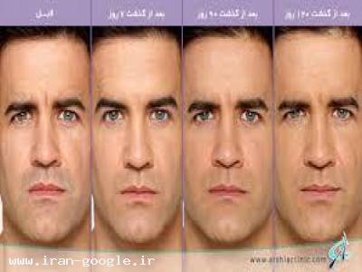 ترمیم وبازسازی پوست بوسیله بوتاکس 