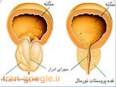 جراحی پروستات با لیزر، جراحی ترمیمی دستگاه تناسلی