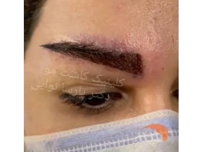 کاشت مو و کاشت ابرو دکتر نوایی اصفهان
