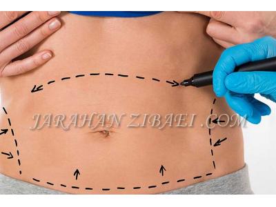 جراحی زیبایی پستان-عمل لیپوماتیک شکم و پهلو