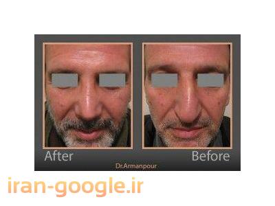 جراحی پلاستیک بینی و شکم ، پروتز سینه