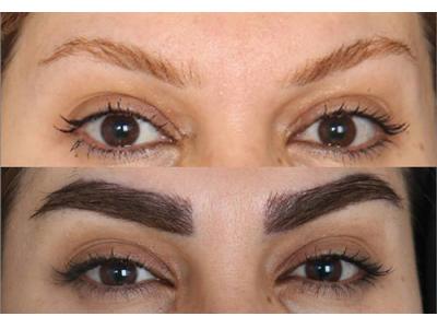 کاشت ابرو بصورت کاملا تخصصی