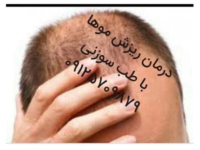 درمان ریزش مو-درمان ریزش مو با طب سوزنی