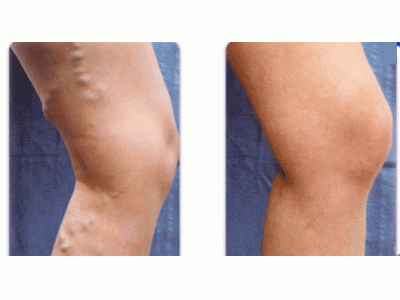 درمان هموروئید ، درمان بواسیر