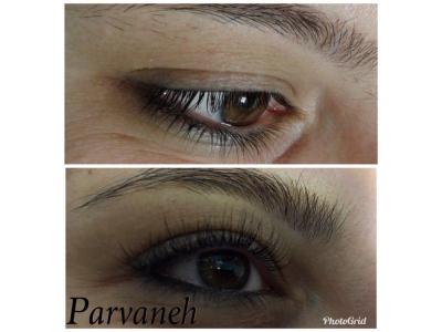 میکروبلیدینگ فیبروز ،حجیم سازی لب ، بن مژه 