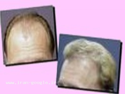 کاشت طبیعی موی سر-مرکز تخصصی کاشت موی طبیعی و قابل FIT کرمان