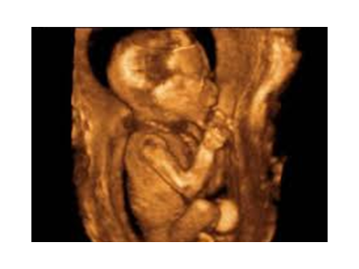 مشاوره بارداری-بهترین مرکز سونوگرافی در تهران nt اکوی قلب جنین