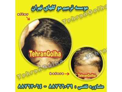 ترمیم مو کاشت مو روش ترمیم مو گلهای تهران ریزش مو درمان ریزش مو آلوپسیهزینه کاشت مو هزینه ترمیم مو-های فیکس آلمان برند برتر ترمیم مو