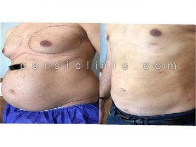 لیپوساکشن بدن شمال تهران