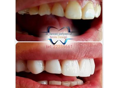  ارتودنسی ، کامپوزیت ونیر ، طراحی لبخند 