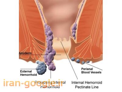 لیزر بواسیر ویژه آقایان و خانم ها - لیزر بواسیر و شقاق بدون جراحی 
