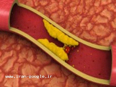 جلوگیری از چربی خون ، کلسترل و اسید اوریک