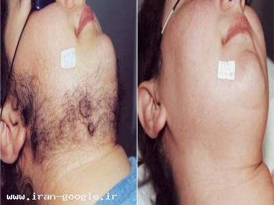 برداشت مو های زاید توسط لیزر