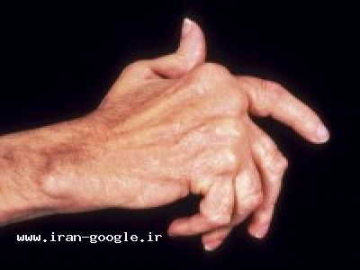 درمان آرتروز و مفاصل 