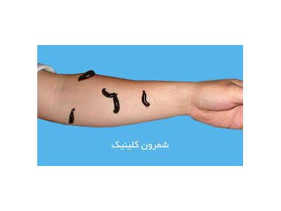 مرکز زالودرمانی ، حجامت و ماساژ شمرون کلینیک