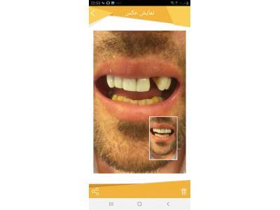 دندان مصنوعی-لابراتوار دندانسازی سعادت آباد