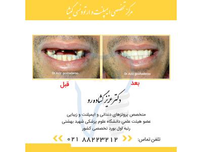 متخصص ایمپلنت تهران-مركز تخصصي دندانپزشكي گيشا
