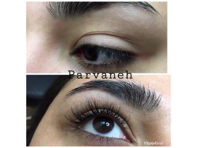 میکروبلیدینگ فیبروز ،حجیم سازی لب ، بن مژه 