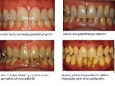 دهان و صورت- تاثیر آب یونیزه قلیایی بر پوسیدگی دندان