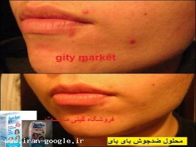 درمان جوش و اکنه با ضد جوش بای بای بلمیش 