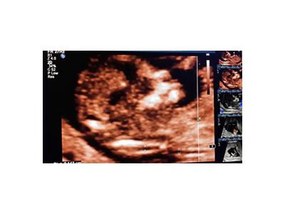 بهترین مرکز سونوگرافی در تهران nt اکوی قلب جنین