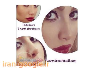 بهترین جراح زیبایی بینی  best iran rhinoplasty 