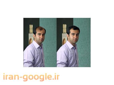 کلینیک کاشت و ترمیم مو پدیده جوان(تار به تار)