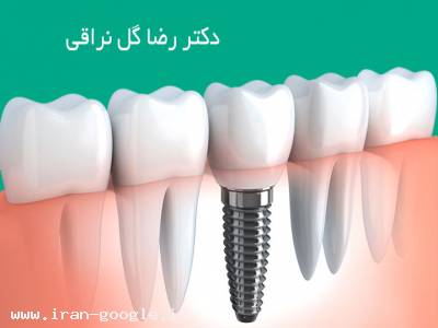 کاشت دندان-متخصص ایمپلنت