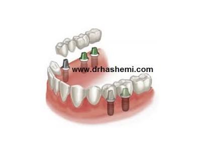 دندانپزشکی تخصصی-مرکز کاشت دندان و زیبایی
