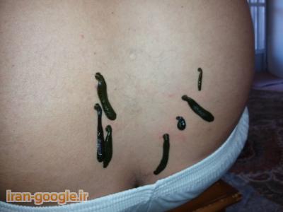 زالودرمانی و حجامت در شیراز