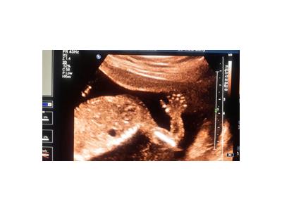 بهترین مرکز سونوگرافی در تهران nt اکوی قلب جنین
