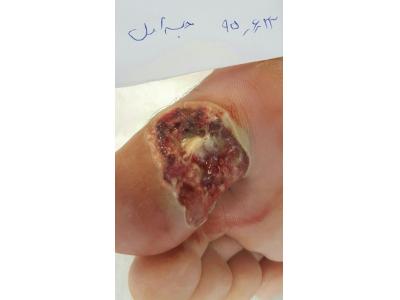 درمان زخم بستر در نیاوران ، درمان زخم دیابت در نیاوران