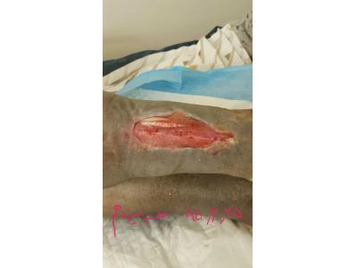 درمان زخم بستر در نیاوران ، درمان زخم دیابت در نیاوران