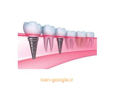 کاشت دندان ثابت-جراح ایمپلنت در محدوده پاسداران 