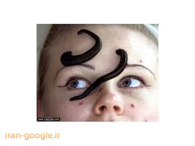 زالو درمانی در شیراز