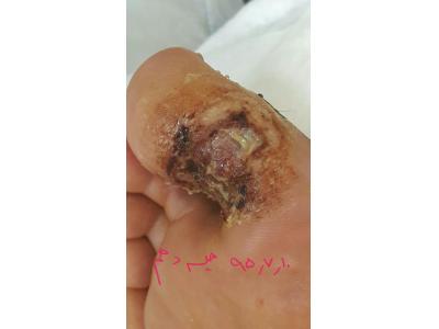 درمان زخم بستر در نیاوران ، درمان زخم دیابت در نیاوران